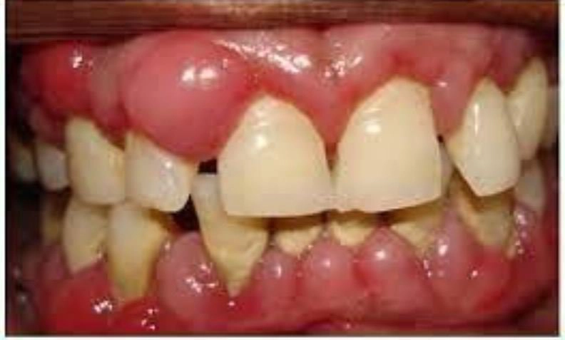 Bị sưng lợi phải làm sao?