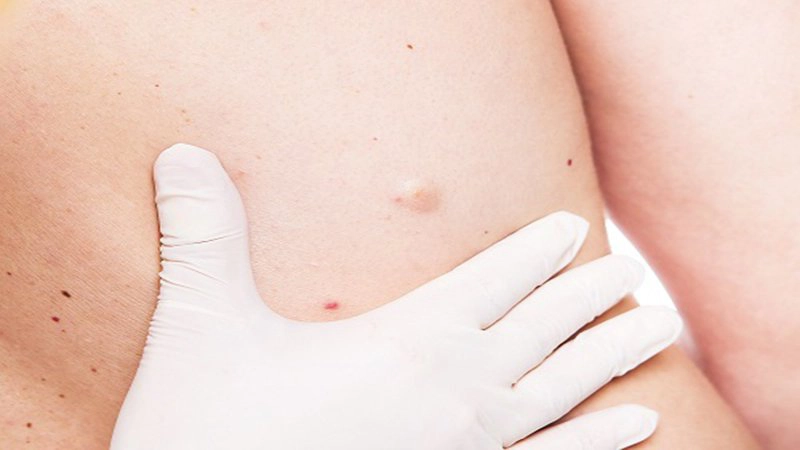 Bị u bã đậu và cách chữa trị hiệu quả