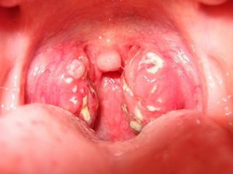 Bị viêm amidan uống thuốc gì?