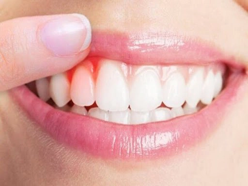 Bị viêm chân răng uống thuốc gì?