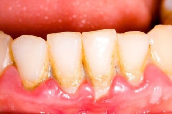Bị viêm lợi uống thuốc gì?