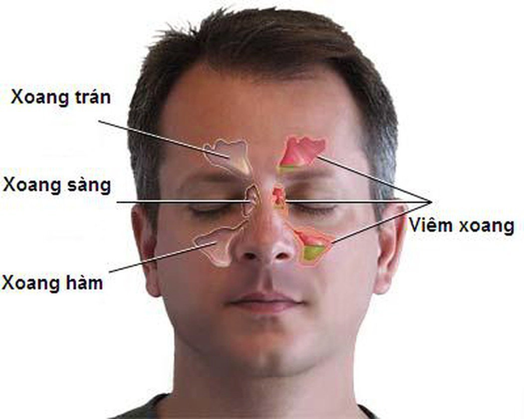 Bị viêm xoang sàng uống thuốc gì?