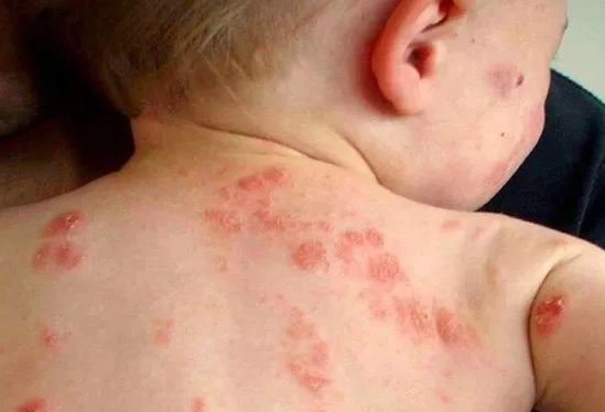 Biến chứng khi bé bị chốc lở