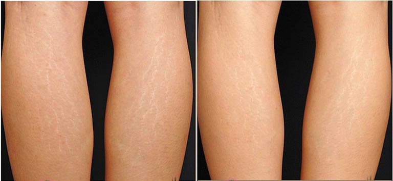 Biện pháp cải thiện rạn da ở bắp chân?