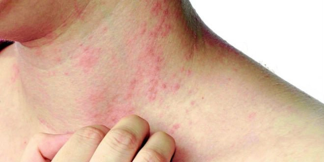 Biểu hiện da của người bị tiểu đường