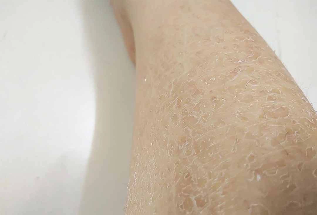 Bong da sau lăn kim có bị lang ben không?