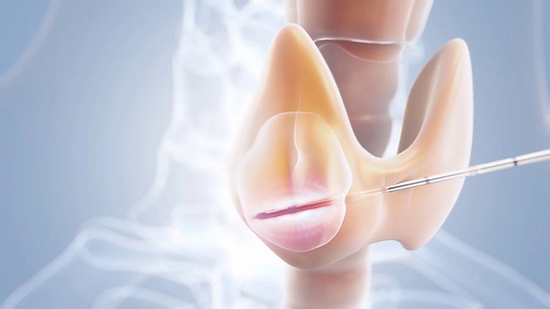 Bướu cổ lành tính kéo dài có cần điều trị không?