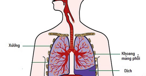 Các biến chứng của lao hạch