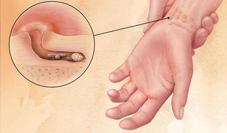 Các cách bắt con cái ghẻ