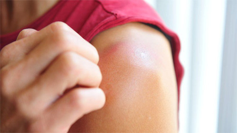 Các cách chữa cháy nắng an toàn