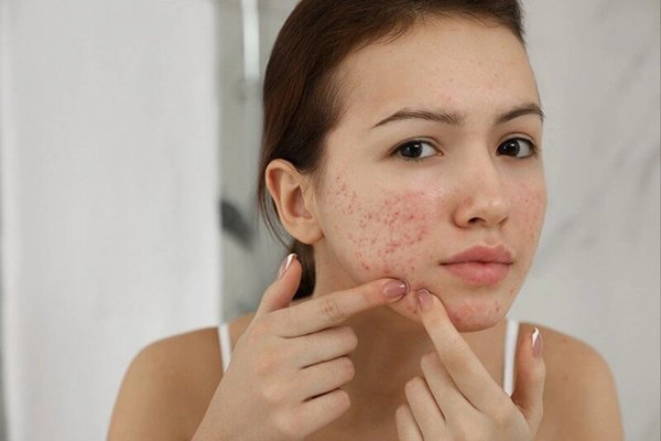 Các cách chữa dị ứng mỹ phẩm