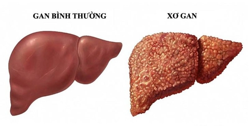 Các cách chữa xơ gan thường dùng