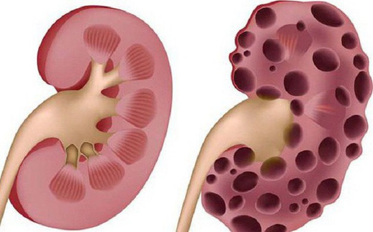 Các cách điều trị suy thận giai đoạn cuối