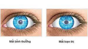 Các cách giảm loạn thị