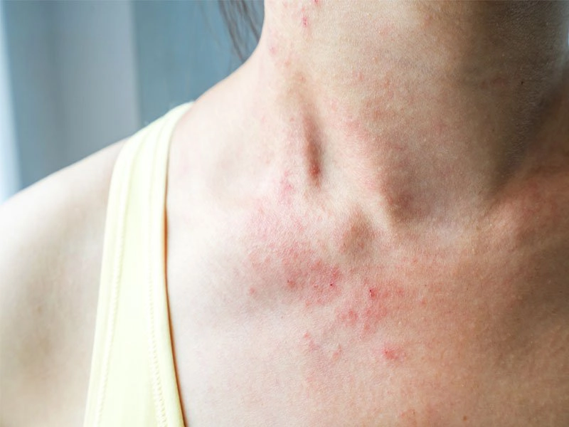 Các cách giảm ngứa khi bị viêm da cơ địa