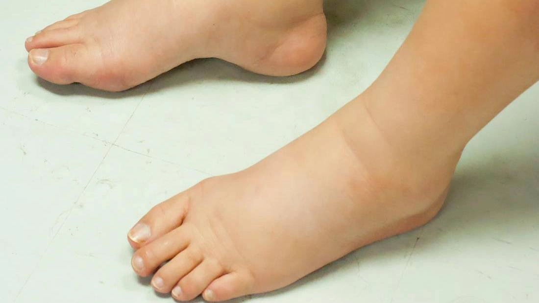 Các cách giảm phù chân