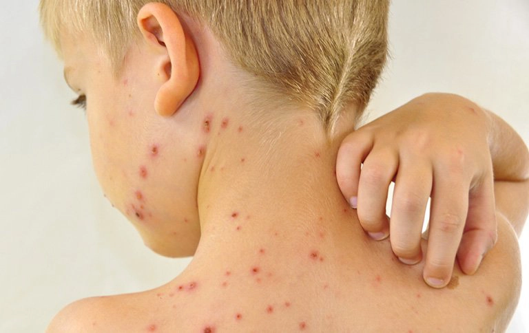 Các cây thuốc nam chữa bệnh thuỷ đậu