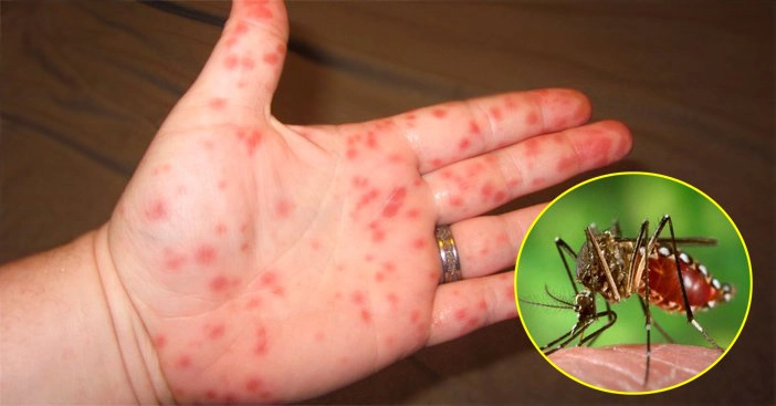 Các điểm cần lưu ý trong phác đồ điều trị sốt xuất huyết Dengue