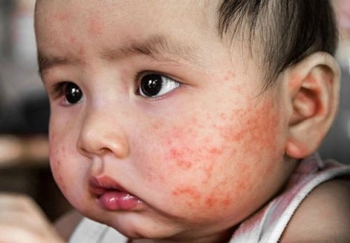 Các loại chàm ở trẻ sơ sinh