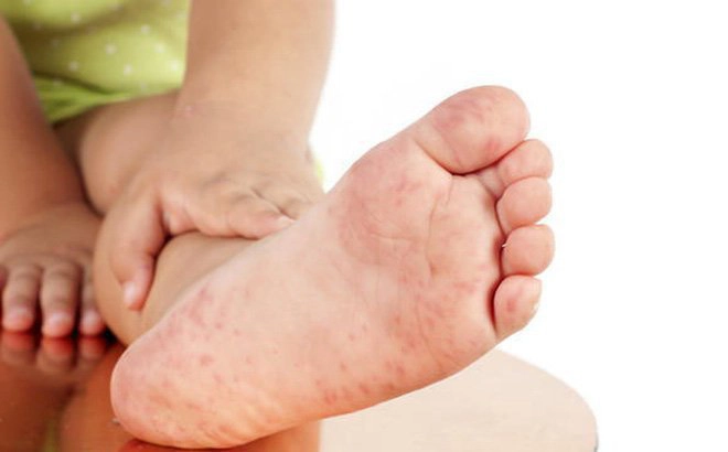 Các nốt mụn nước của bệnh chân tay miệng mọc ở đâu trước?
