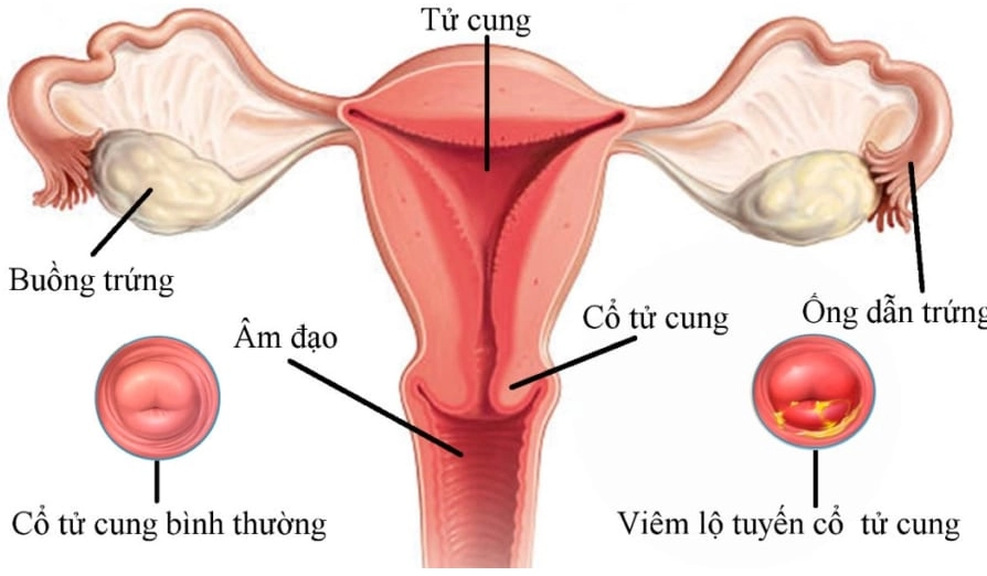 Các phương pháp chữa viêm lộ tuyến cổ tử cung