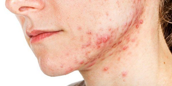Các phương pháp xét nghiệm và chẩn đoán viêm da dầu (tiết bã)
