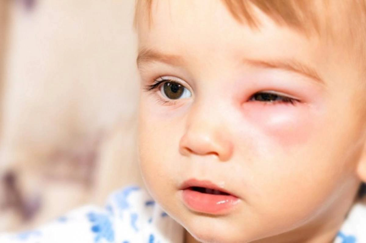 Các thuốc trị lẹo mắt cho trẻ