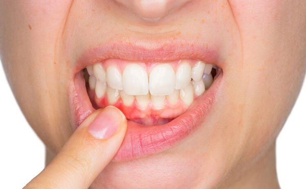 Các thuốc trị viêm nướu răng