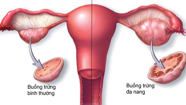 Các tiêu chuẩn chẩn đoán buồng trứng đa nang