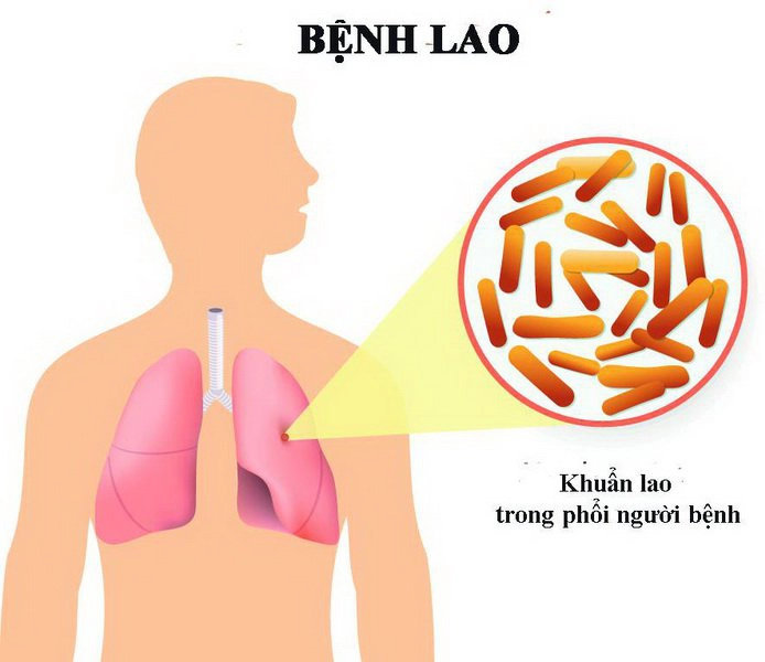 Các triệu chứng của bệnh lao phổi tái phát