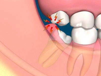 Các triệu chứng mọc răng khôn điển hình
