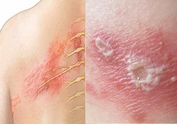 Các vấn đề về da thường gặp ở người lớn: Bệnh zona, nổi mề đay và hơn thế nữa