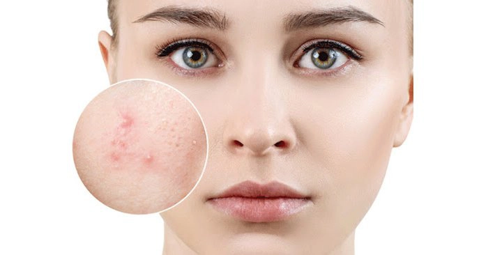 Cách chăm sóc da dầu mụn lỗ chân lông to