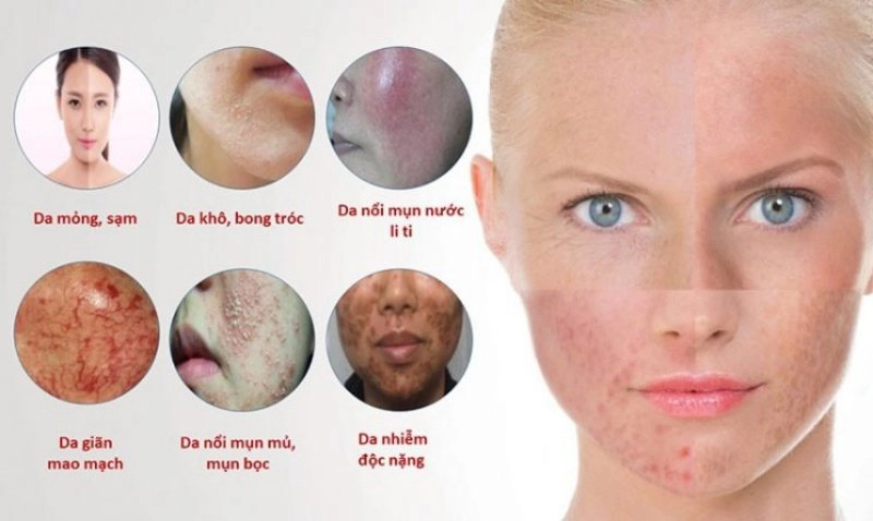 Cách chữa da bị nhiễm corticoid