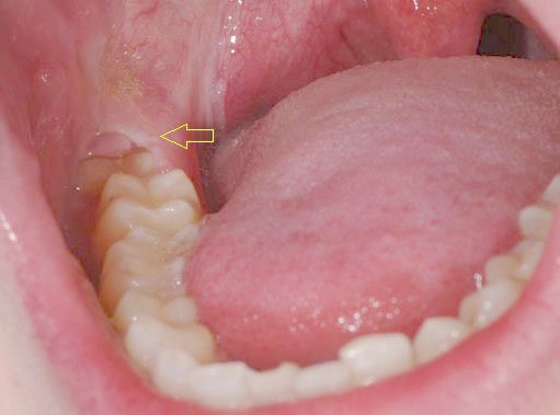 Cách chữa đau răng số 8 (răng khôn)