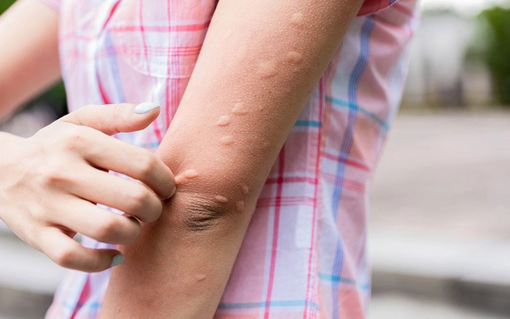 Cách chữa dị ứng nổi mề đay tại nhà