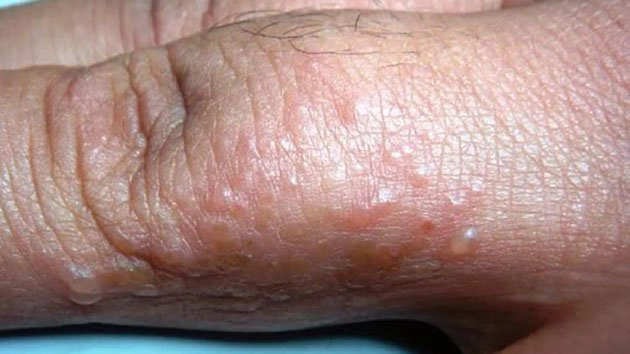 Cách chữa ghẻ nước như thế nào?