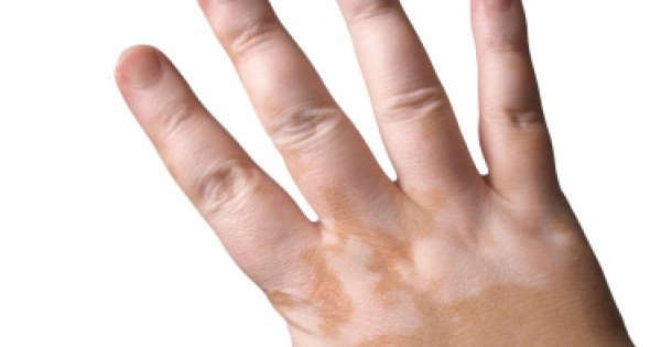 Cách chữa lang ben ở trẻ em