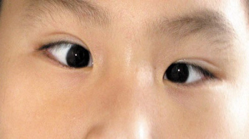 Cách chữa mắt lác ở người lớn tại nhà