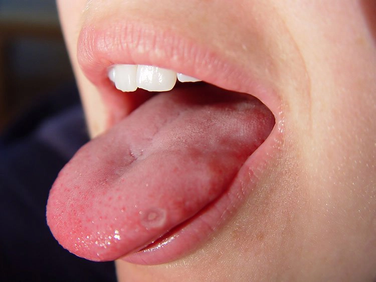 Cách chữa nhiệt lưỡi hiệu quả nhanh