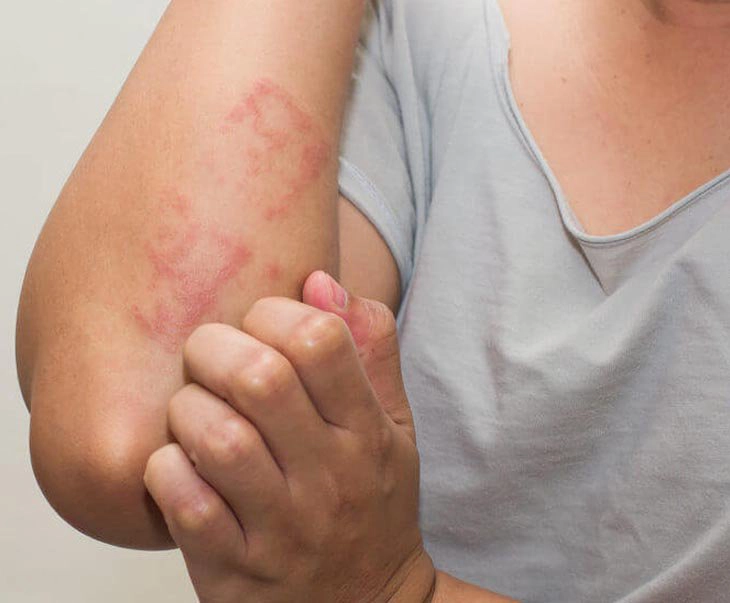 Cách chữa nổi mề đay hiệu quả