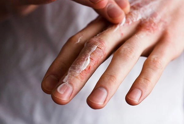 CÁCH CHỮA NỨT ĐẦU NGÓN TAY