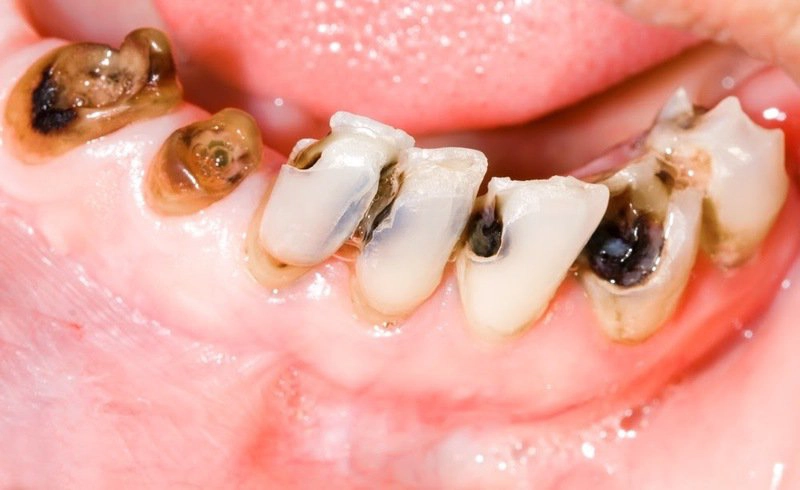 Cách chữa sâu răng cho người lớn