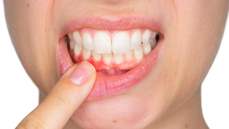 Cách chữa viêm lợi tại nhà
