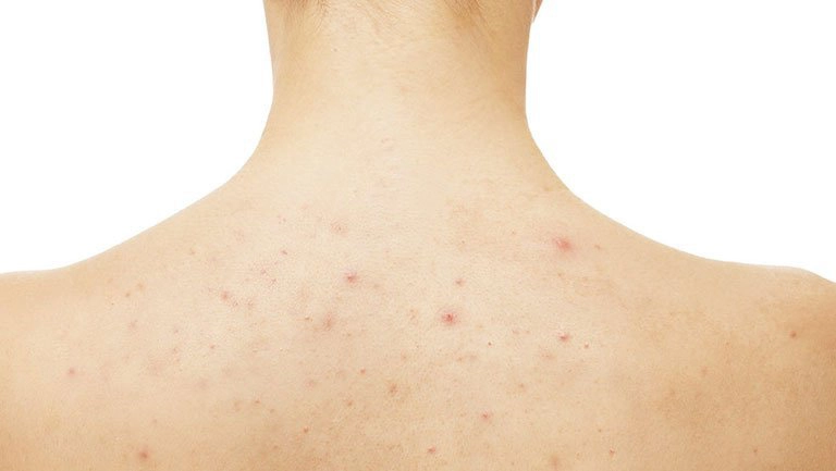 Cách chữa viêm nang lông triệt để