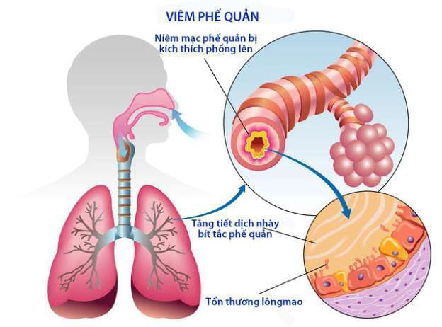 Cách chữa viêm phế quản không dùng kháng sinh