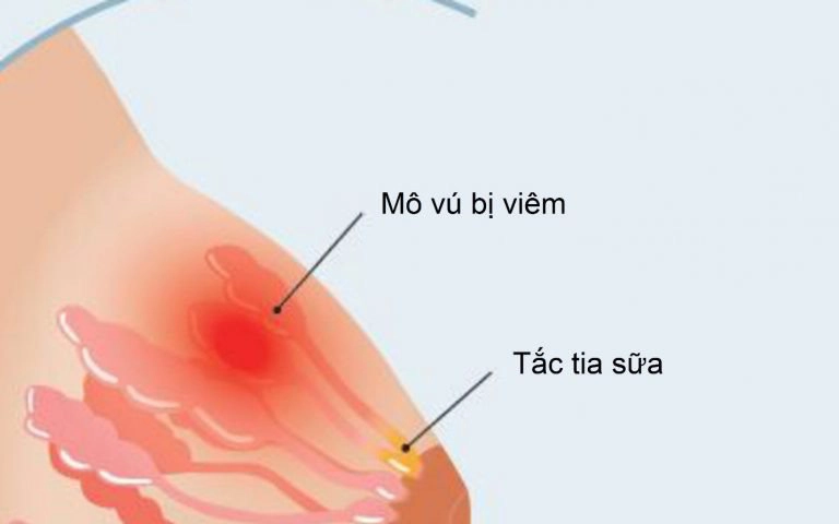 Cách điều trị tắc tia sữa
