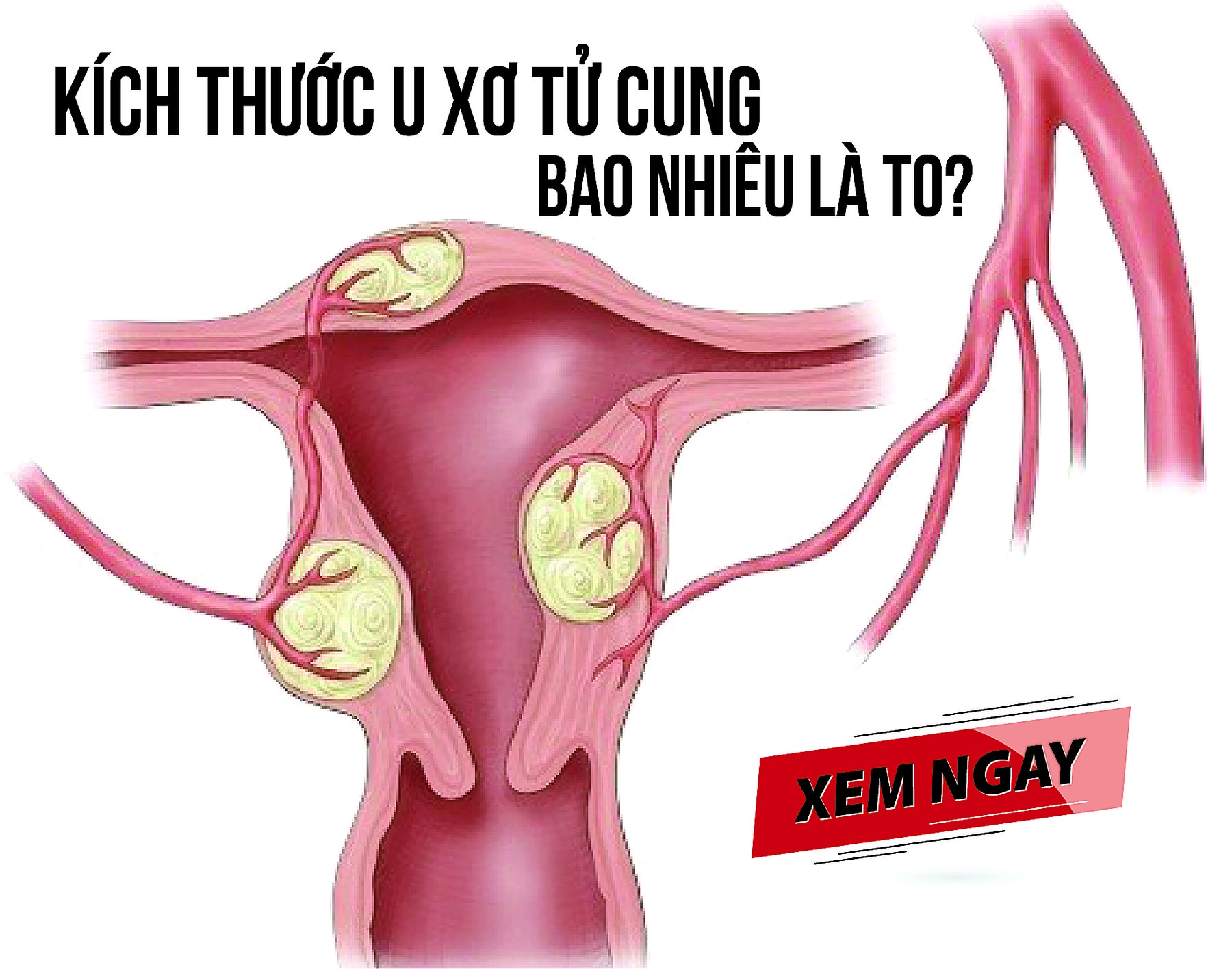 Cách giảm kích thước u xơ tử cung