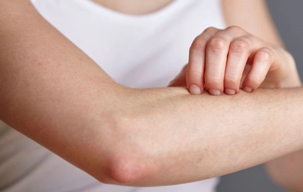 Cách giảm ngứa khi phát ban sốt xuất huyết