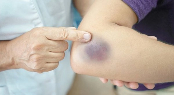 Cách giảm sưng khi bị va đập phần mềm cơ thể
